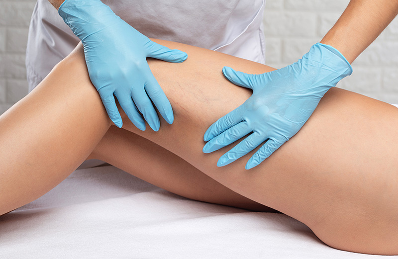 Sclerotherapy treatment on legs